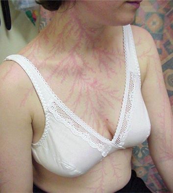 arboriforme